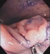 Normal lift with submucosal