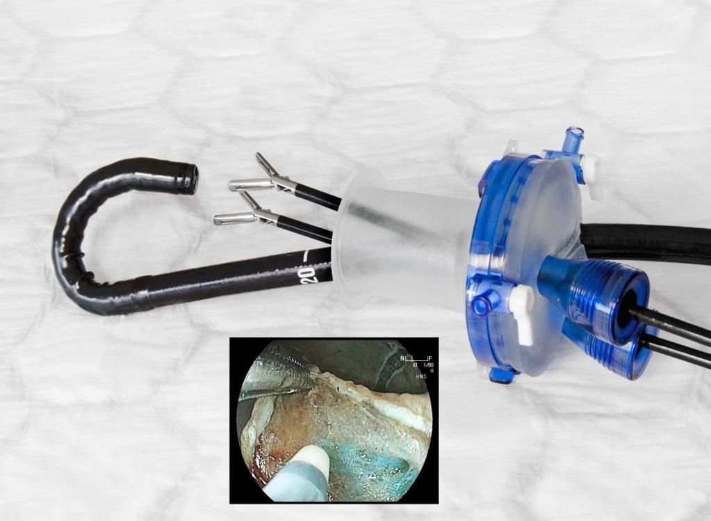 TASER technique: ideal platform for complex rectal polyp resection (P-EMR, ESD, etamis) Gel air-tight seal Endoscope - CO2 insufflation - visualisation - cutting/coagulation/clipping 1-2 laparoscopic
