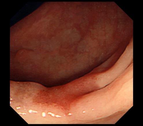 Colonic Polyps Colonic polyps tend to be protuberant lesions in the