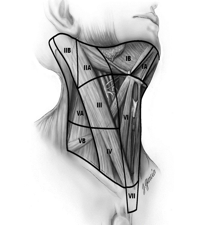 Surgery Modified radical neck dissection Levels II-V Intraoperative findings of multiple enlarged, dark and cystic appearing lymph nodes, consistent with papillary
