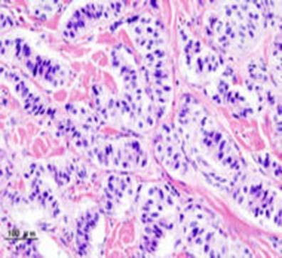 Pathology Papillary thyroid carcinoma involving 7/31