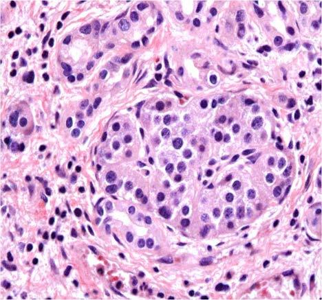 nodes Immunopathology Insulin stain highlights enlarged