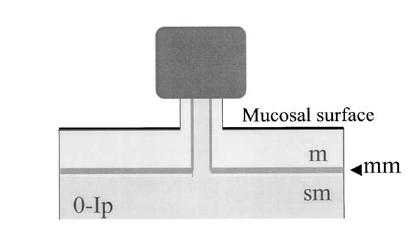 Step 1: basics Pedunculated (0-Ip): Base is more narrow than top of lesion M= mucosa, mm= muscularis mucosae, sm= submucosa The Paris endoscopic classification of