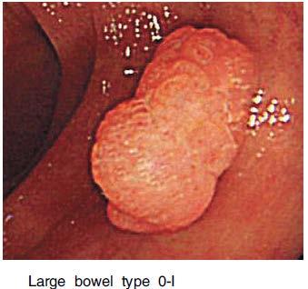 Step 2: examples Photo example 1: 0-Is The Paris endoscopic classification of superficial neoplastic lesions: esophagus, stomach,