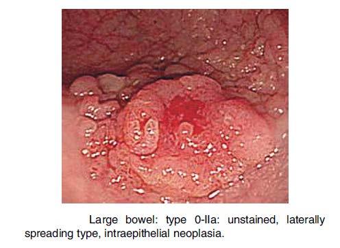 Step 2: examples Photo example 3: 0-IIa The Paris endoscopic classification of superficial neoplastic lesions: esophagus, stomach,