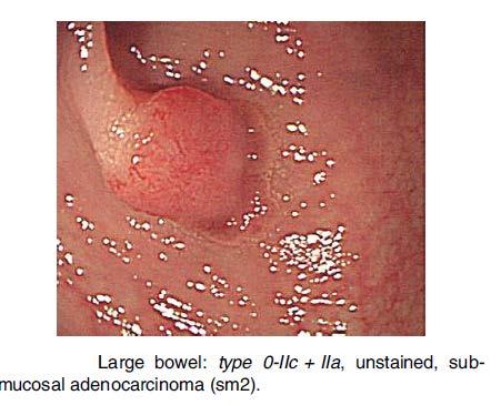 Step 2: examples Photo example 5: 0-IIc + IIa The Paris endoscopic classification of superficial neoplastic lesions: esophagus,
