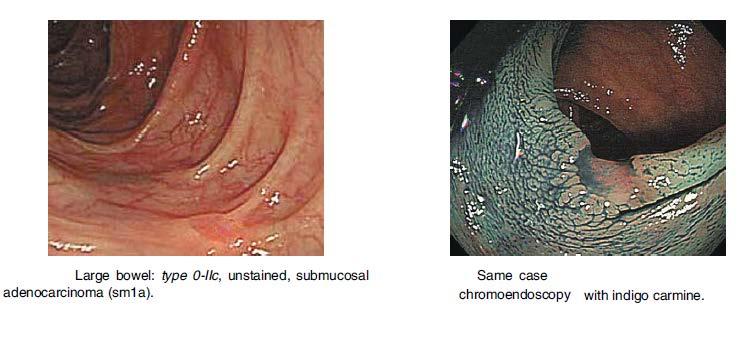 Step 2: examples Photo example 6: 0-IIc The Paris endoscopic classification of superficial neoplastic lesions: esophagus, stomach,