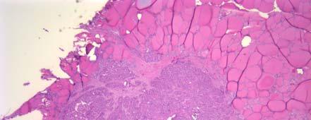 Microscopic Papillary Carcinoma 34 Microscopic