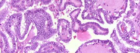 Papillary carcinoma Follicular Derived Follicular carcinoma Hurthle cell carcinoma 5 5 Thyroid Facts Up to 70% of the population will have a