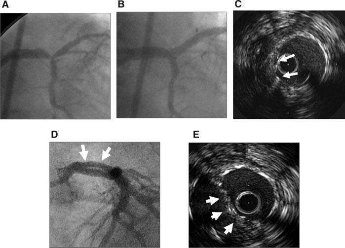 844 Kim et al. TABLE VI. Lesion Characteristics and Clinical Outcome of Patients with Restenoses Site Used stents (mm) Restenosis Carinal diaphragm Treatment Male, 62 years LM Two 3.