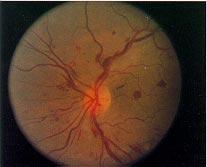 sickle-cell retinopathy. Fig. 6.