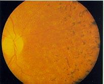 10 Optic atrophy following papillitis, with