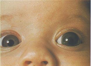 Congenital Glaucoma and Congenital Cataract Fig. 8.