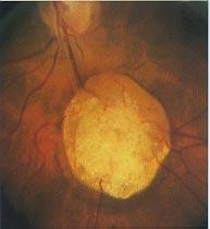 face with unilateral glaucoma in