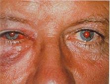 Ocular Injury Associated with Head Injury Fig. 9.