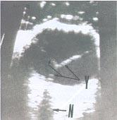 injection (fundal fluorescein angiography). Fig. 1.