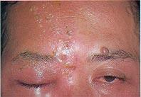 3 Herpes zoster ophthalmicus with