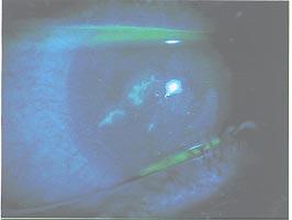 Dendritic Corneal Ulcers Dendritic ulcer is major cause of severe visual loss from