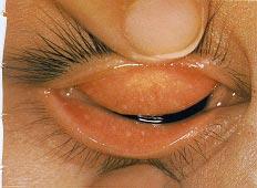Conjunctival Follicles and Papillae Fig. 3.