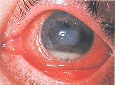 use of soft contact lens. Fig. 3.