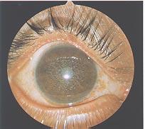 Corneal Dystrophies Fig. 3.