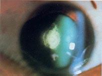 Cataract Fig. 4.