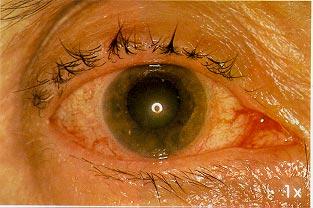 Closed-angle Glaucoma Fig. 4.