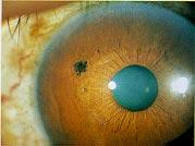 13 Laser iridotomy is the treatment of