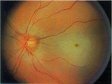 Retinal Vessel Occlusion Fig. 5.