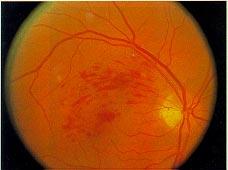 5 Central retinal vein occlusion showing multiple flame-shaped