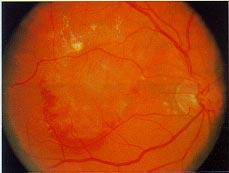 (Note visible choroidal vessels and atrophy around
