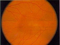 17 Disciform macular degeneration of old age with
