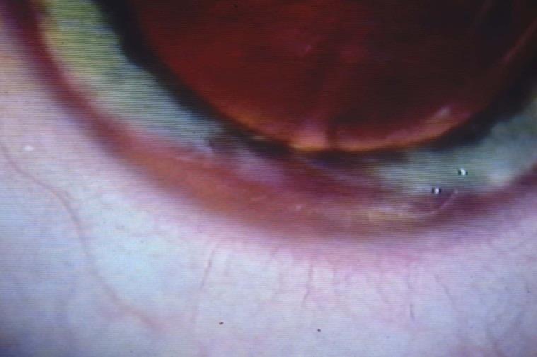 Additional measures 2 Topical Atropine for cycloplegia Subconjunctival