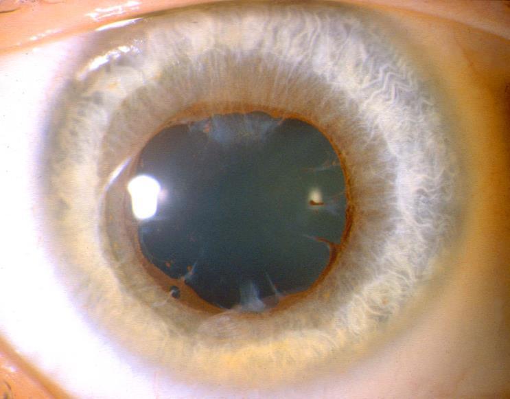 Children with JIA-associated uveitis? Traditionally NO IOL!
