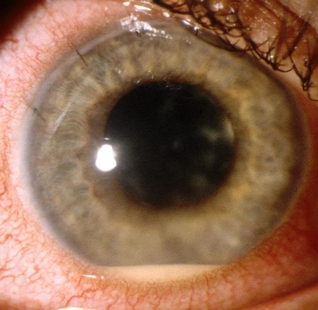 Problems of Cataract in Uveitis What is the current level of