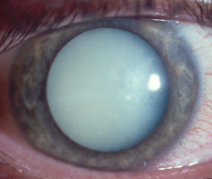 Problems of Cataract in Uveitis Young patients (MUC mean age 43): Unilateral