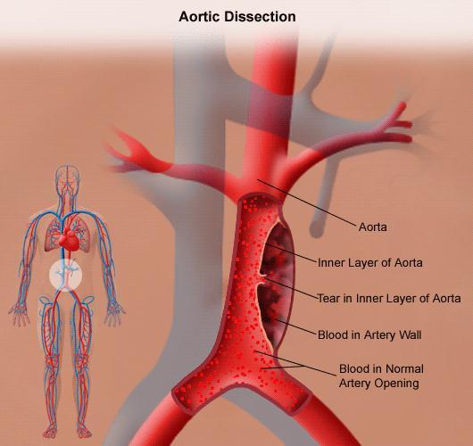 com/aorticdissection-treatment