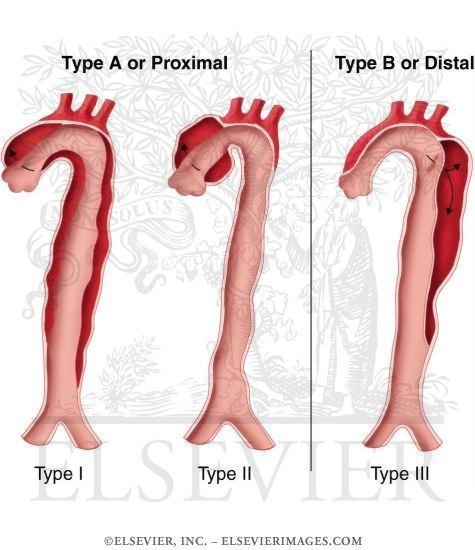 Classification of aortic dissections Image A represents a Stanford A or a DeBakey type 1 dissection.
