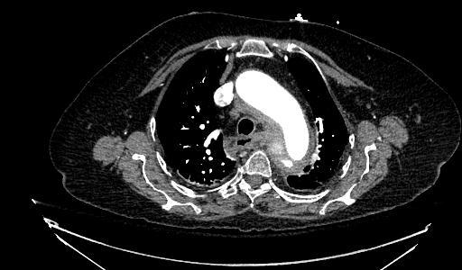 Our Patient: Aortic Arch on Chest CT