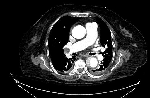 Our Patient: Pulmonary Embolus on Chest CT Ascending Aorta Pulmonary
