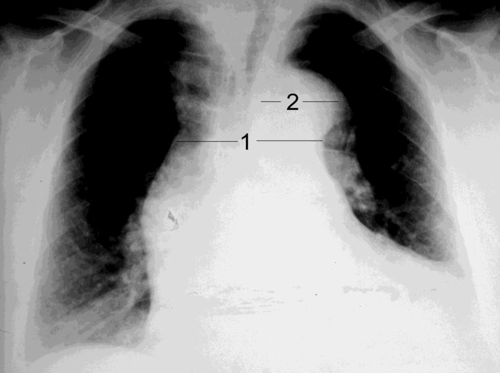 Companion Patient #1: Aortic Dissection on Chest X-Ray Widened Aortic Knob Widened