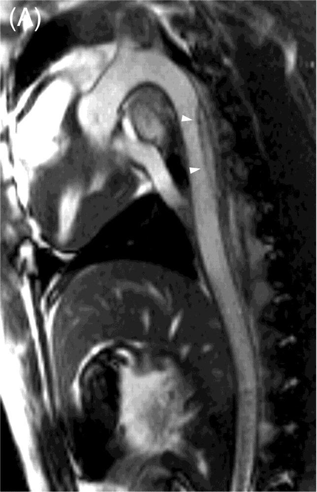 Companion Patient #2: Aortic Dissection on MRI Entry Site Re-entry Site False Lumen Descending Aorta High-resolution
