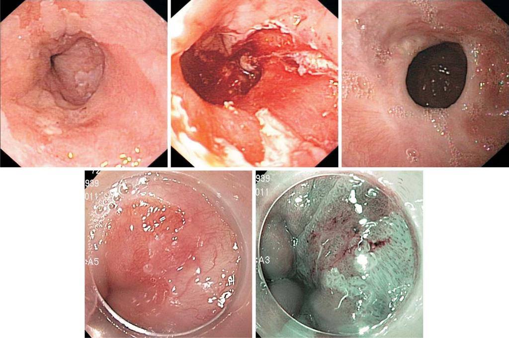 Figure 3 Example of a patient with focal neoplasia (high-grade intraepithelial neoplasia) in a short Barrett oesophagus (upper left) treated by endoscopic mucosal resection (upper middle), followed
