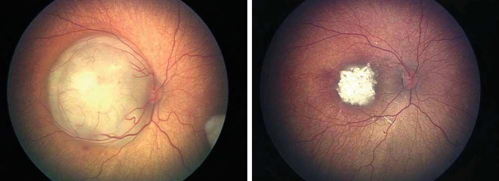 A B Figure 3. Regression of macular retinoblastoma following chemoreduction and foveal-sparing transpupillary thermotherapy. A, Before treatment.