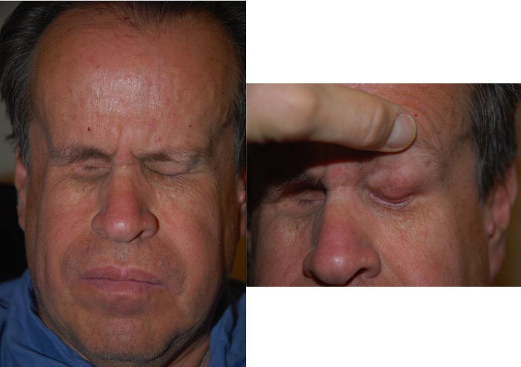 Figure 1: External photos demonstrate bilateral enucleation for hereditary retinoblastoma with an hourglass configuration of