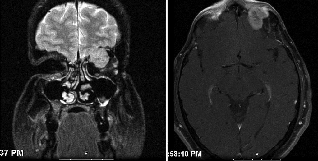 There was a palpable superior mass in the left orbit Figure 2: MRI shows a soft tissue mass subjacent to the left orbital
