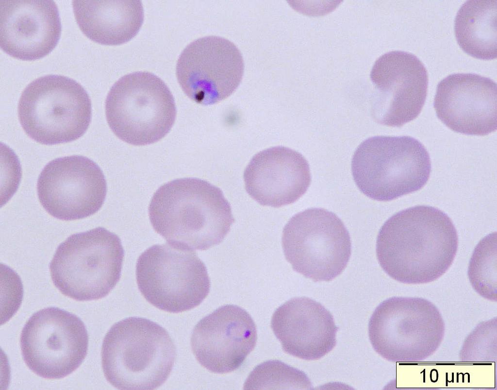 Plasmodium malariae: upper compact ring with