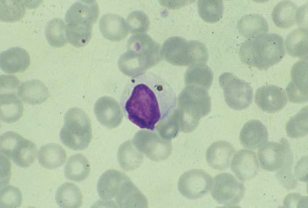 Malaria pigment (thin film).