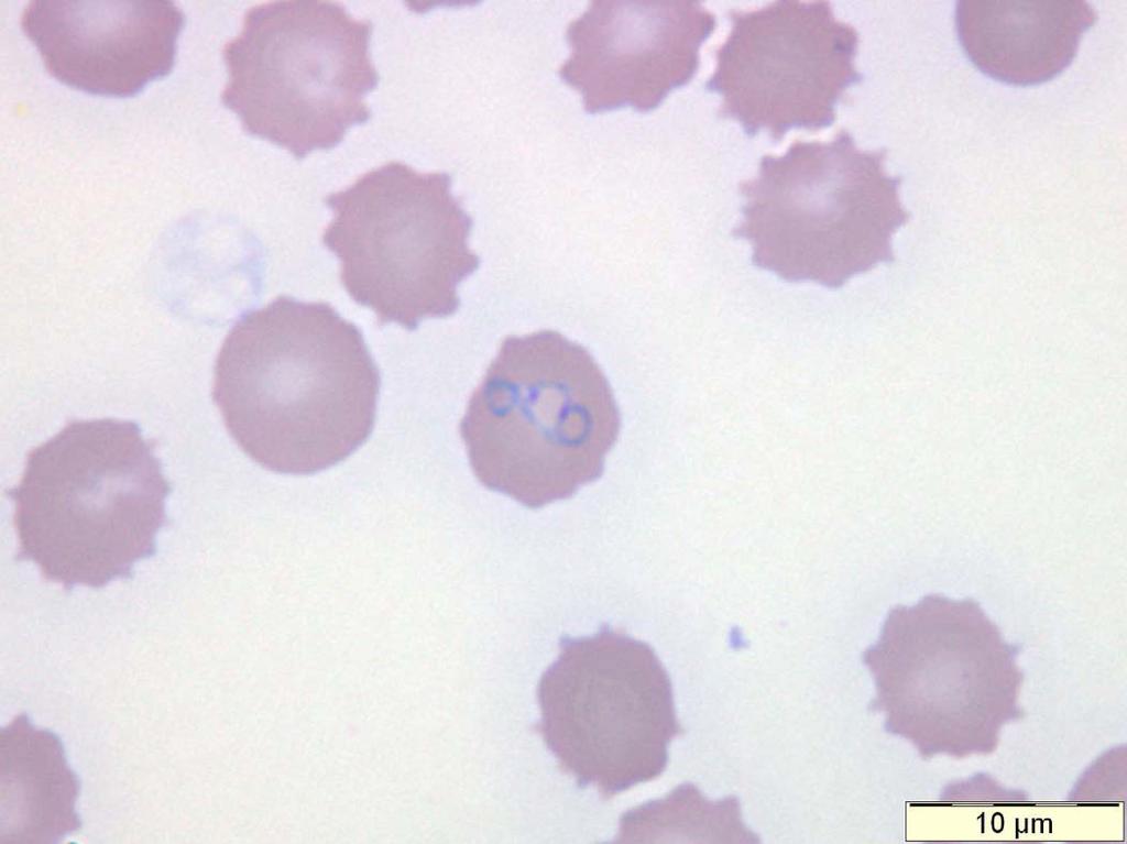 Babesia microti: multiply infected