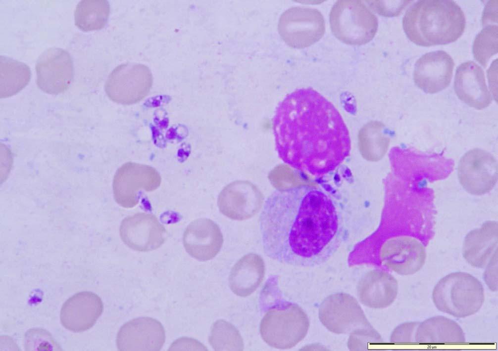 Leishmania sp. Ovoid small (2-6 μm) parasites in a bone marrow aspirate.